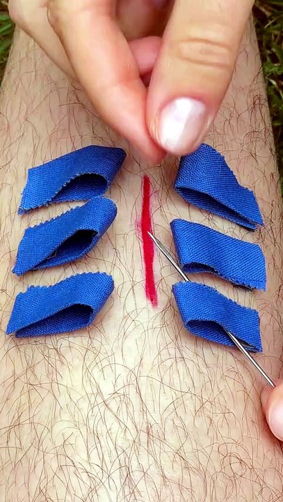 Emergency wound patching method