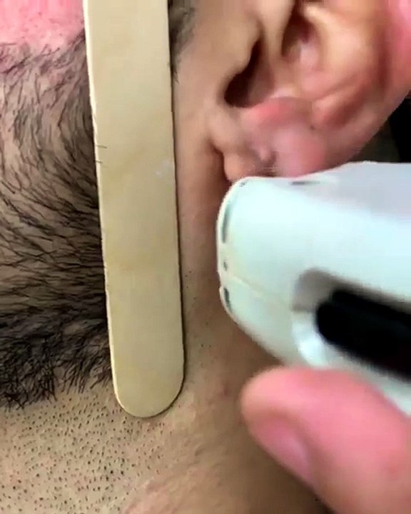 How Laser Hair Removal Works for Men's Beard