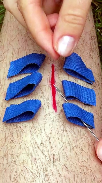 Emergency wound patching method