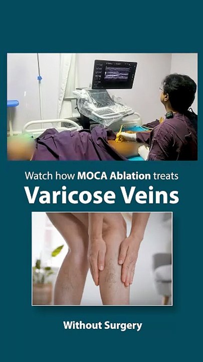 Varicose veins treatment