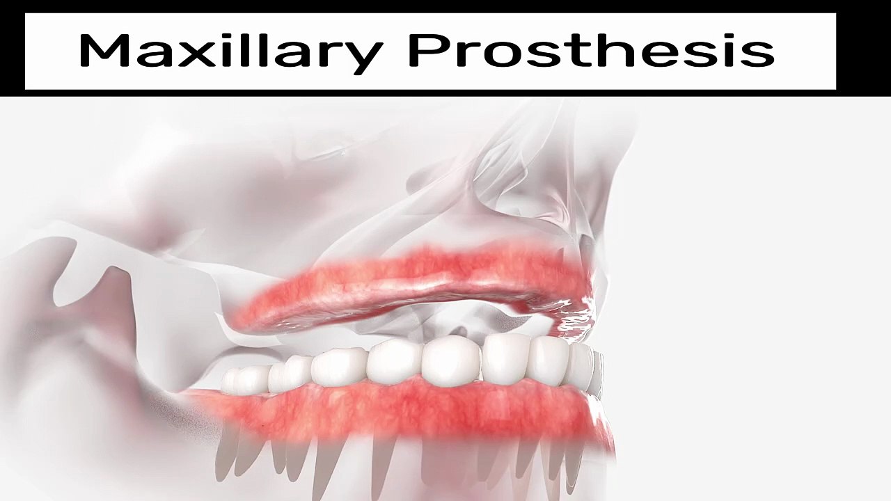 How is a maxillary prosthesis fitted?