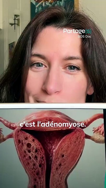 Vous connaissez l'endométriose, mais qu'est-ce que l'adénomyose ? Réponse de notre experte médicale