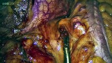 Surgeons: At the Edge of Life S08E04 - Back from the Brink