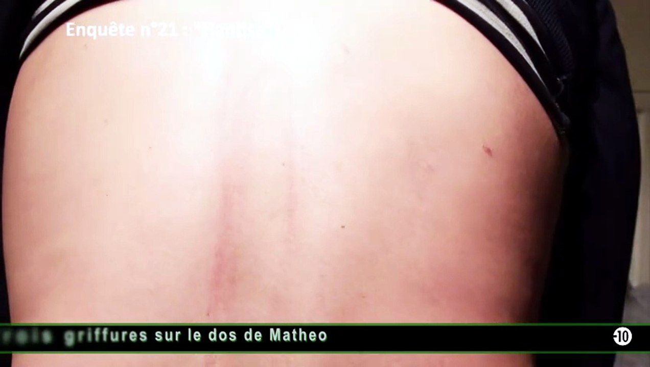 Griffures sur le dos de Matheo - Extrait de l'enquête n°21