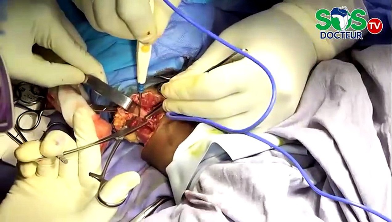 Le traitement traditionnel d’une fracture qui aboutit à l’amputation d'un bras.