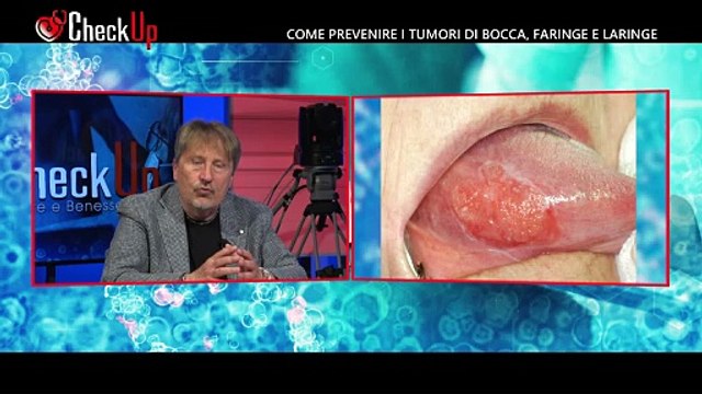 Check-Up Come prevenire i tumori di bocca, faringe e laringe del 15-05-24 | Check-Up Come prevenire i tumori di bocca, faringe e laringe del 15-05-24