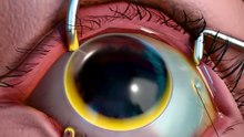 How Eyeball Jewelry Surgery Works 😨
