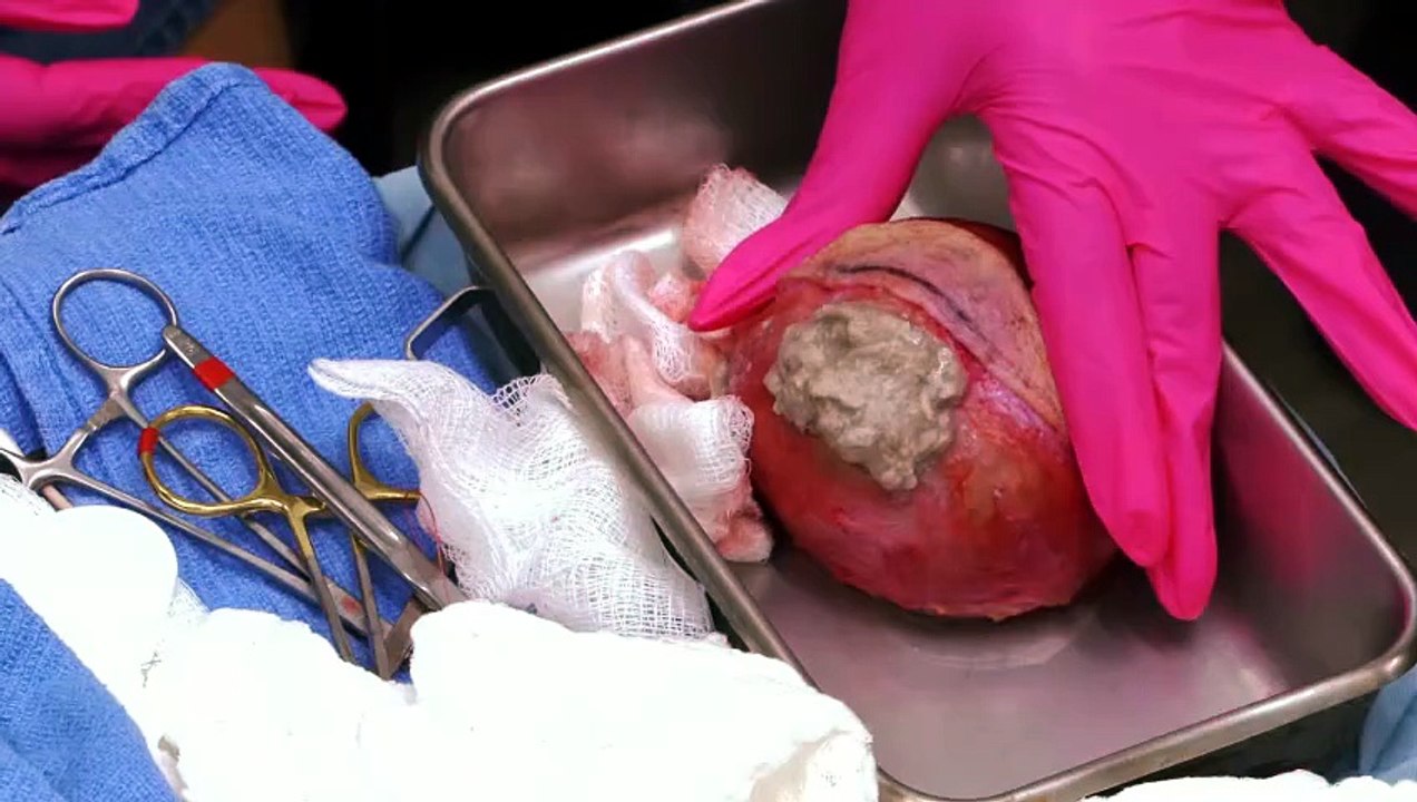 Dr Pimple Popper Breaking Out S02E02 Gone in CYST Y Seconds H 264