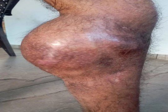 Ahmedabad: सिविल अस्पताल में हेमोफीलिया के 669 मरीजों का महंगे इंजेक्शन देकर निशुल्क उपचार