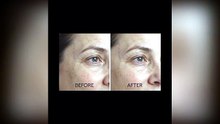 Fractional RF Skin Rejuvenation — Before & After Results | Velvet Skin London