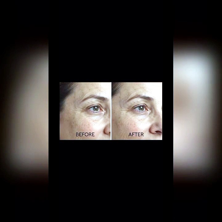 Fractional RF Skin Rejuvenation — Before & Afte...