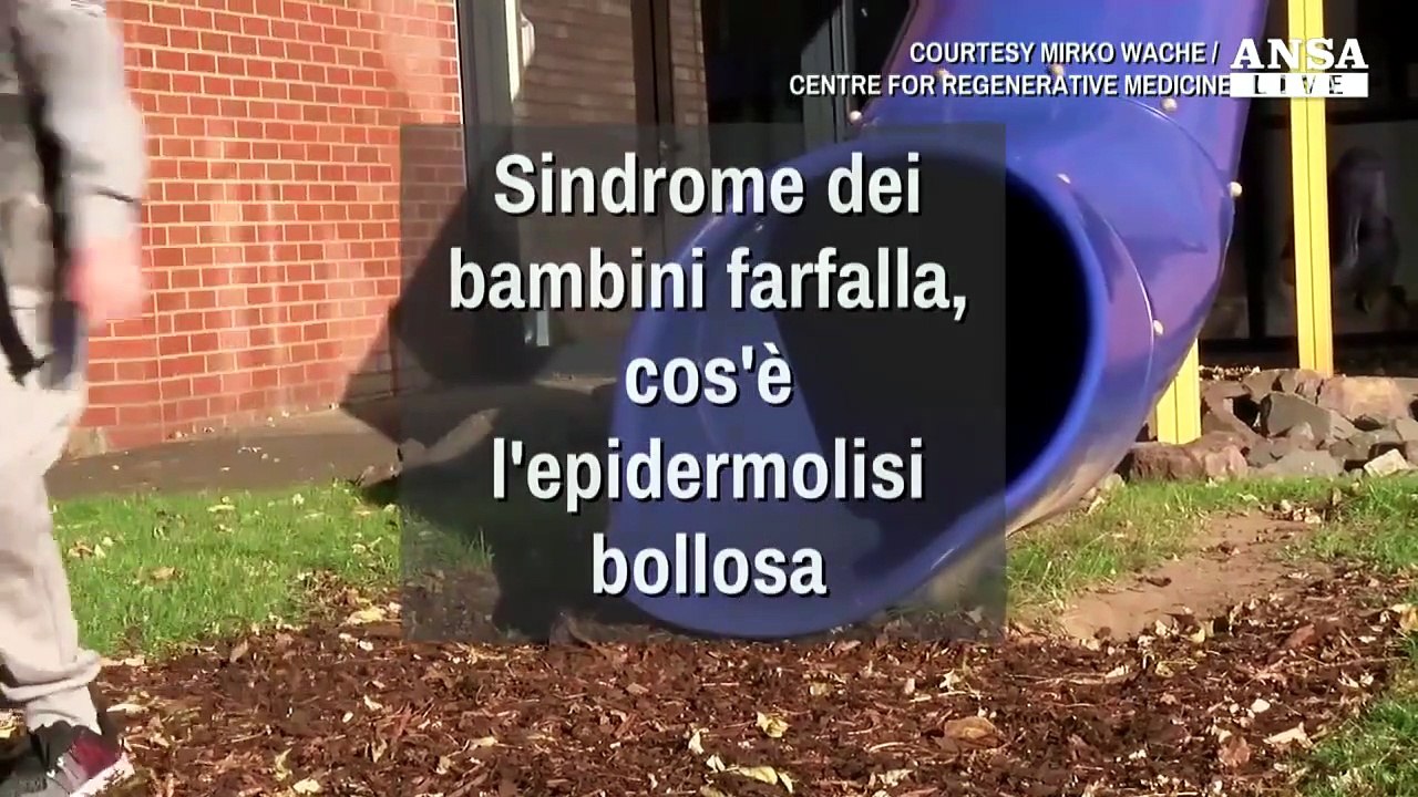 'Bambini farfalla', cos'e' l'epidermolisi bollosa