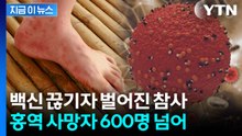 홍역 대유행 비상...방글라데시서 600명 넘게 숨졌다 [지금이뉴스] / YTN