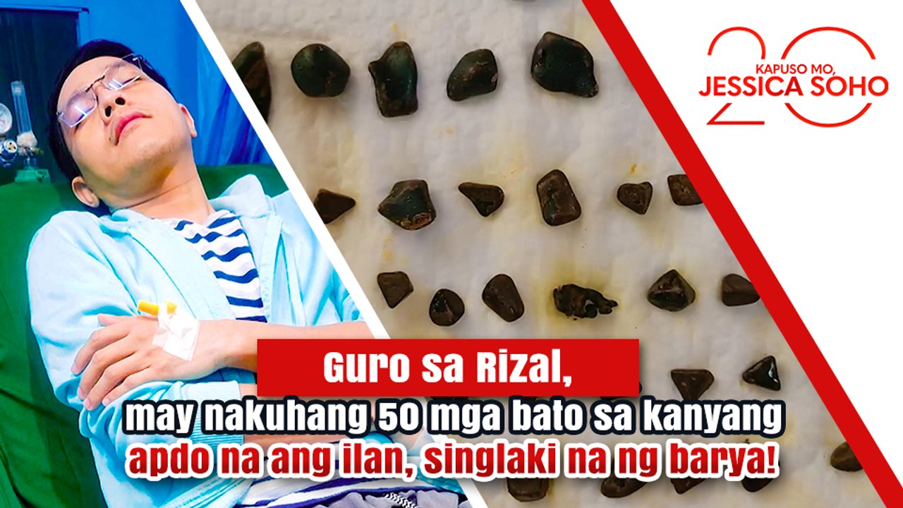 Guro, may 50 mga bato sa kanyang apdo na ang ilan, singlaki na ng barya! | Kapuso Mo, Jessica Soho