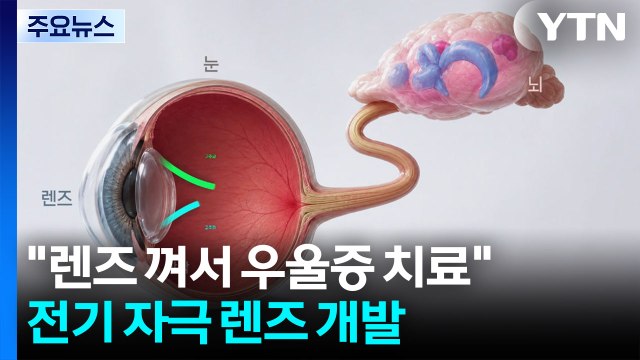 렌즈 껴서 우울증 치료 ...전기 자극 렌즈 개발 / YTN