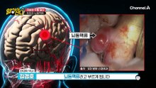 극심한 두통 앓다 찾아온 뇌동맥류! 망치로 머리를 맞은 듯한 통증이다?