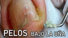 No quiere tratar la causa de los callos subungueales y las uñas deformes