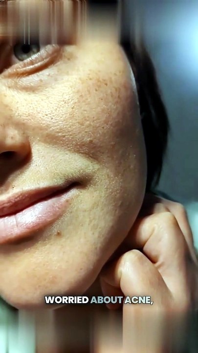 Tretinoin Cream (Tretiheal) | Acne Management and Skin Improvement