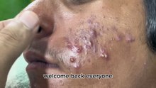 Sacdepspa Big Deep Blackheads Treatment