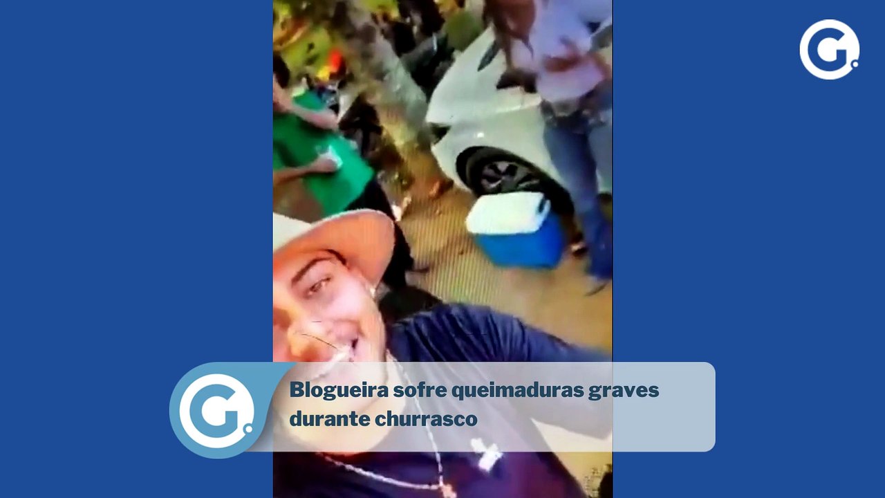 Blogueira sofre queimaduras graves  durante churrasco
