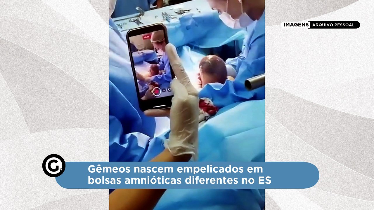 Gêmeos nascem empelicados em bolsas amnióticas diferentes no ES