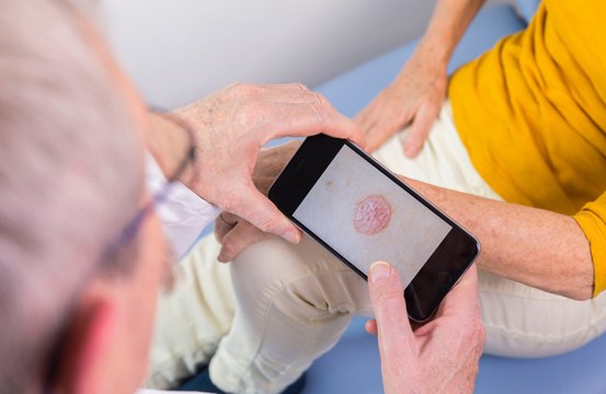 AI app detects skin cancer warning signs through smartphone camera