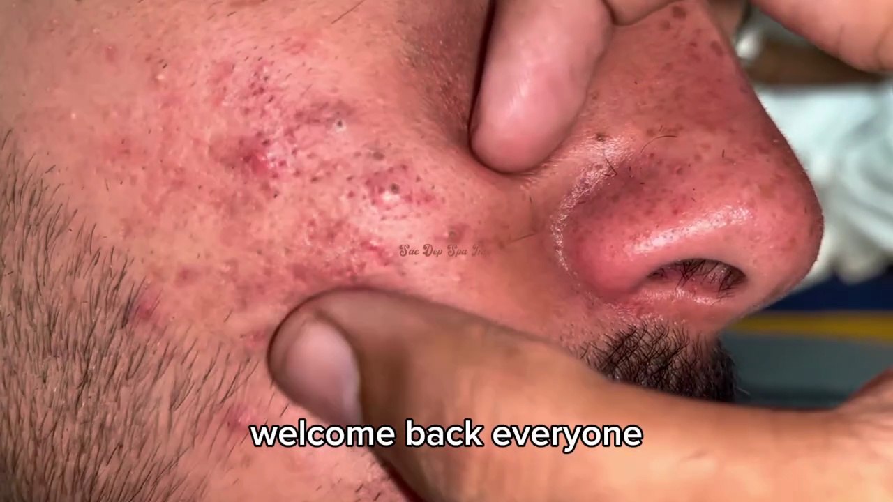 Sac dep spa Big Deep Blackheads Treatment pimple popping asmr
