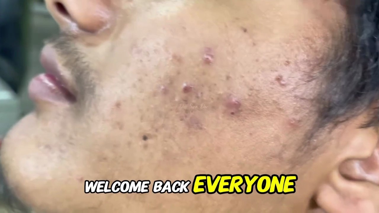 blackheads acne blackheads removal | pimple popping Today new | by Sac Dep Spa into 2026