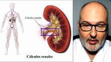 Piedras en el riñón: por qué se forman, qué síntomas provocan y cómo prevenirlas