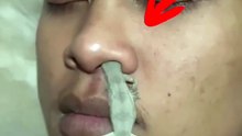 A Gecko Climbed Into His Nostril... No Reaction!