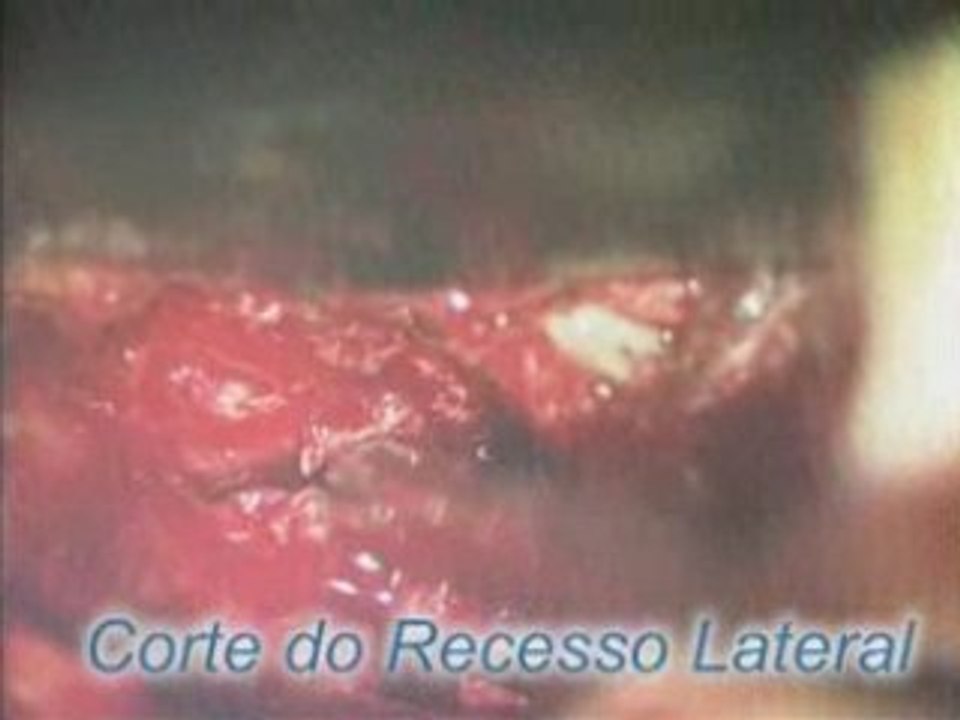 Hérnia de disco - Laminectomy - Hemilaminectomy