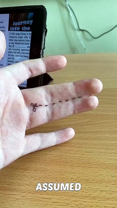 Unbelievable Joined Fingers 😱 Rare Human Condition You Won't Believe! #Shorts
