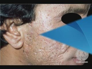 Acne Scar Removal