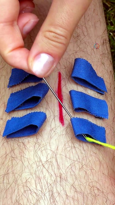 Emergency wound patching method