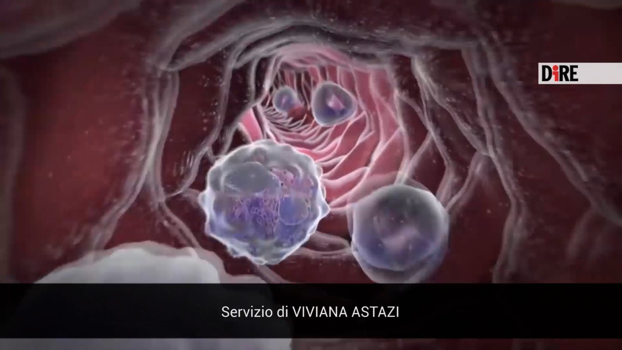 Leucemia mieloide cronica, le nuove opzioni terapeutiche efficaci