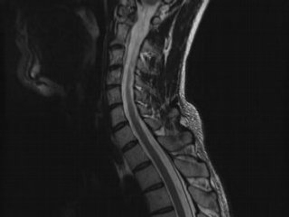 IRM Cervicales