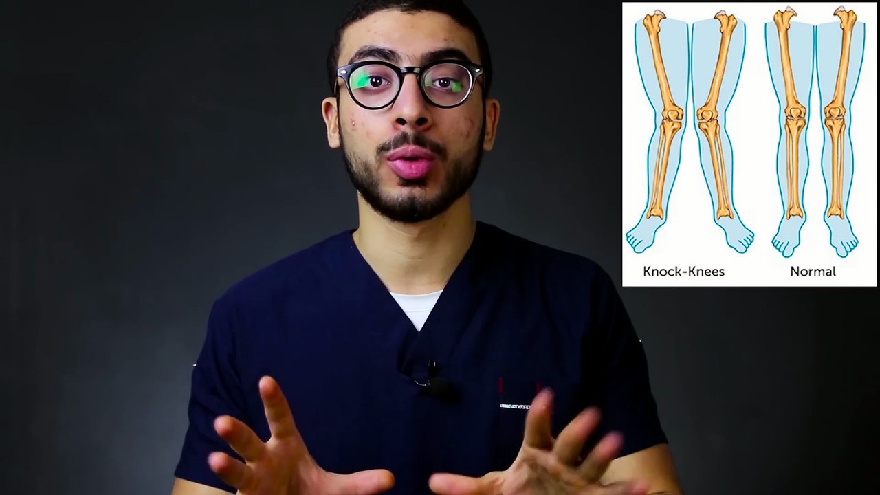 034 - علاج تقوس الساقين عند الاطفال والكبار (علاج التصاق الفخذين)