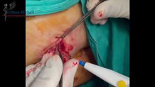 Μυοεπιθηλίωμα (Mixed Tumour) | Χειρουργική Αφαίρεση Όγκου Ράχης με Τοπική Αναισθησία