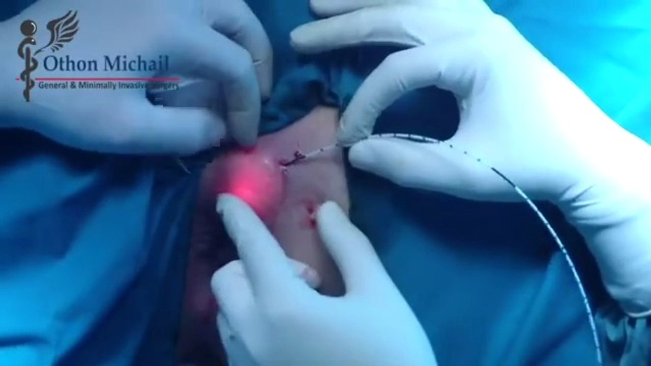 Περιεδρικό Συρίγγιο | Θεραπεία με Laser FiLaC®