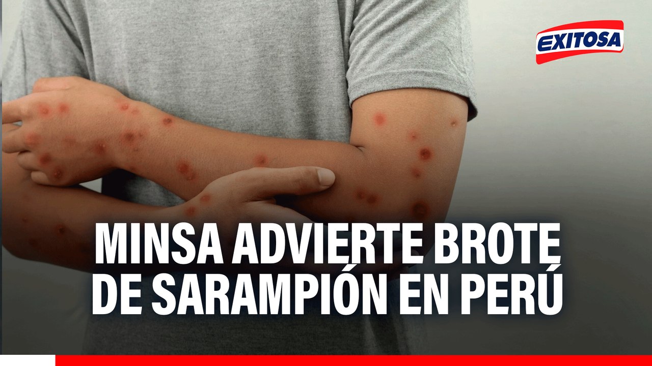 Alerta por brote de sarampión en el Perú: Hay un 60% de casos en personas entre los 18 y 25 años