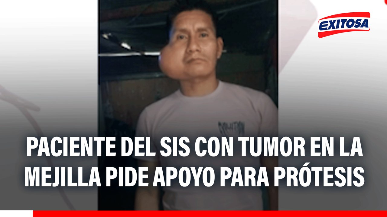 Paciente del SIS con tumor en la mejilla pide apoyo para prótesis de S/ 42 mil tras operación