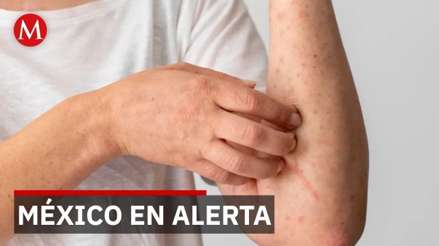 Autoridades reportan nuevos contagios de sarampión mientras el brote sigue activo en México