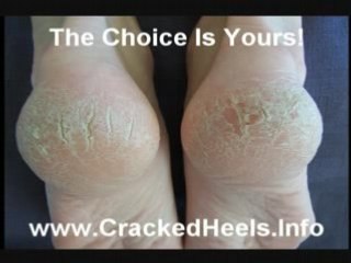 Cracked Heels