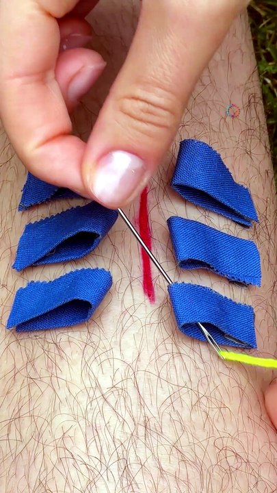 Emergency wound patching method