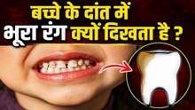 Teeth Brown Stain Removal: बच्चे के दांत में भूरा धाग होने का कारण,इलाज क्या है ?