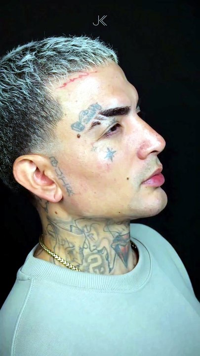 VÍDEO: Mc Guimê mostra novo visual após harmonização facial: “Um pouco inchado”