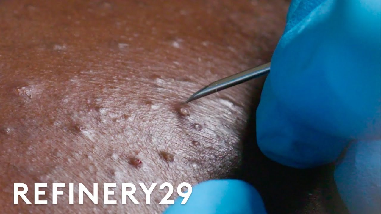 I Got Professional Blackhead Extractions | Macro Beauty | Refinery29