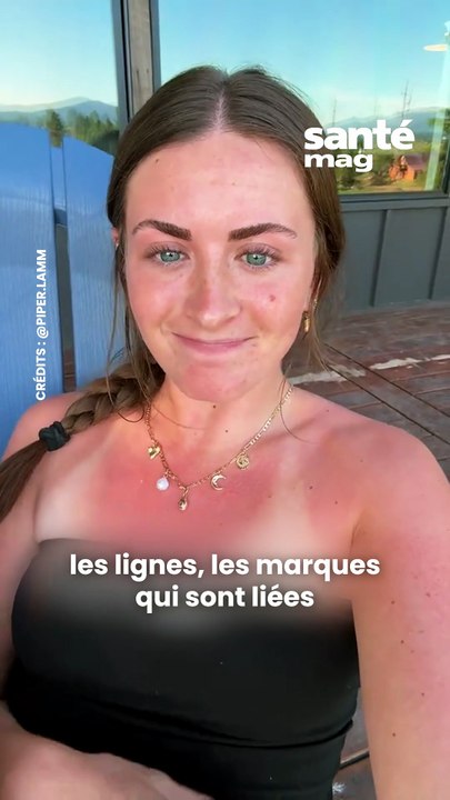 La tendance "coups de soleil" décryptée par une dermato