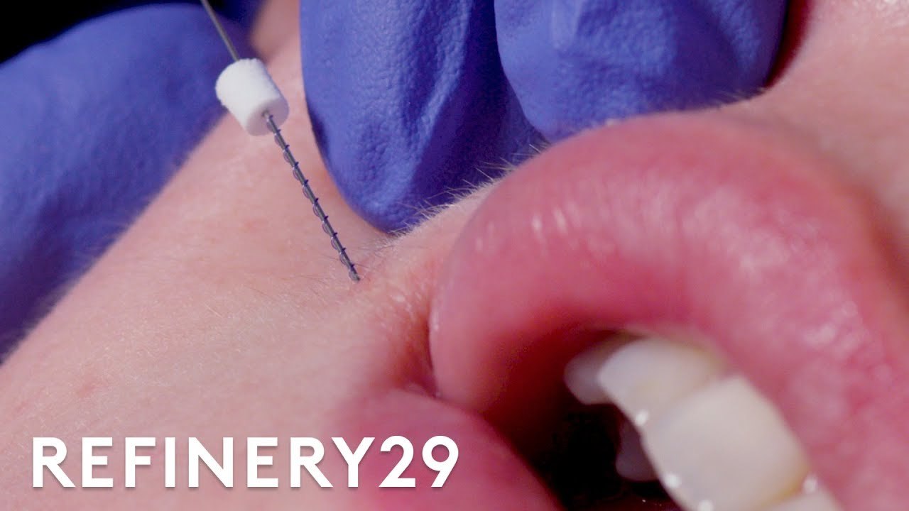 I Got Threads Injected Into My Lips | Macro Beauty | Refinery29