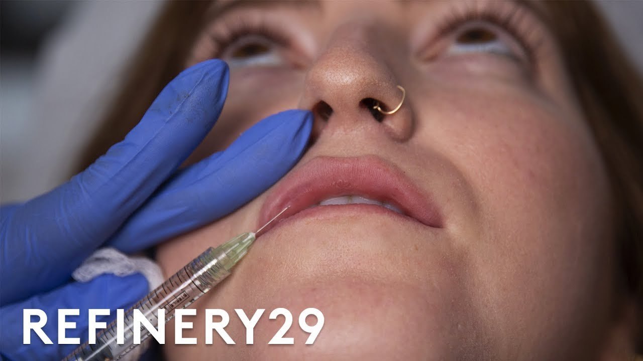 I Got Lip Filler Injections For The First Time...